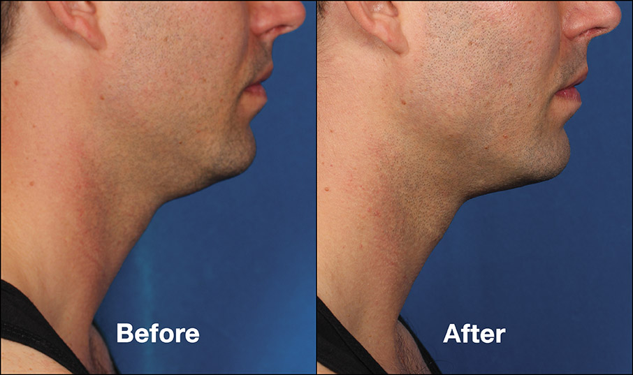 kybella_before after 1b